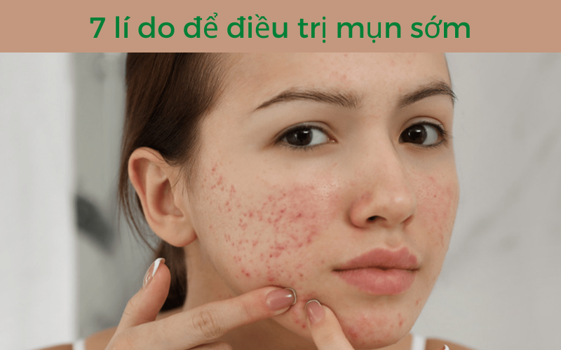 7 lí do để điều trị mụn sớm