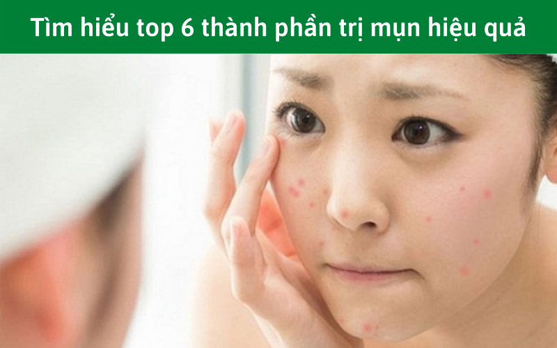 Tìm hiểu top 6 thành phần trị mụn hiệu quả