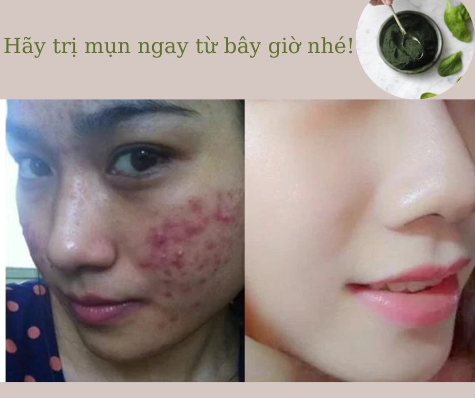 Trị mụn với tảo xoắn spirulina